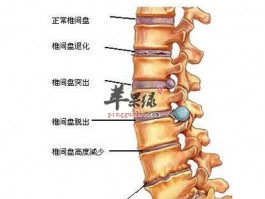 治腰椎间盘突出症的偏方